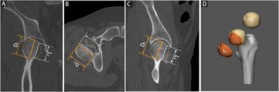Fractured morphology of femoral head associated with subsequent femoral neck fracture: Injury analyses of 2D and 3D models of femoral head fractures with computed tomography